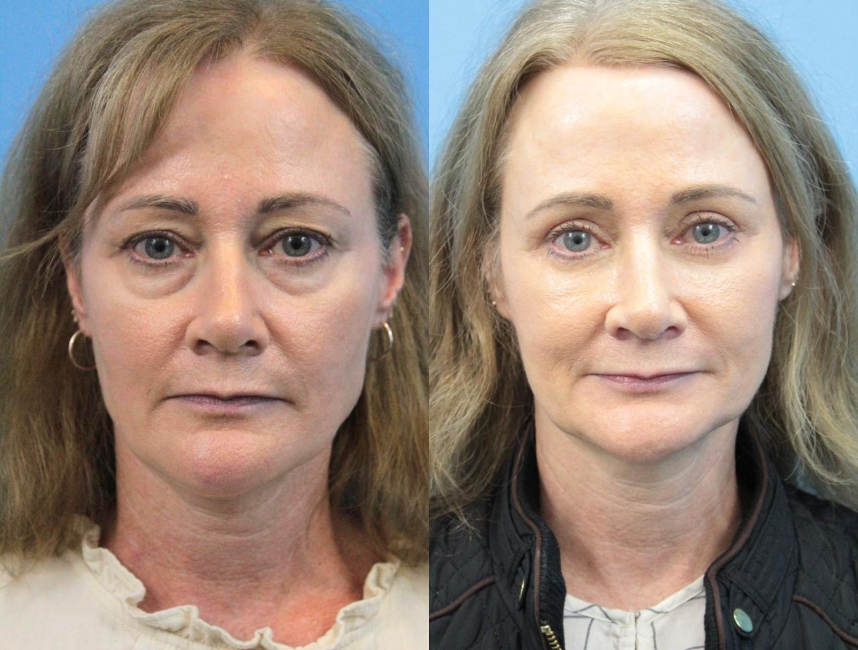 Before & After Eyelid Surgery (Upper Eyelid Lift) Case 367 Front View in West Des Moines & Ames, IA