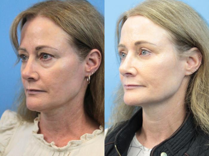 Before & After Eyelid Surgery (Upper Eyelid Lift) Case 367 Left Oblique View in West Des Moines & Ames, IA