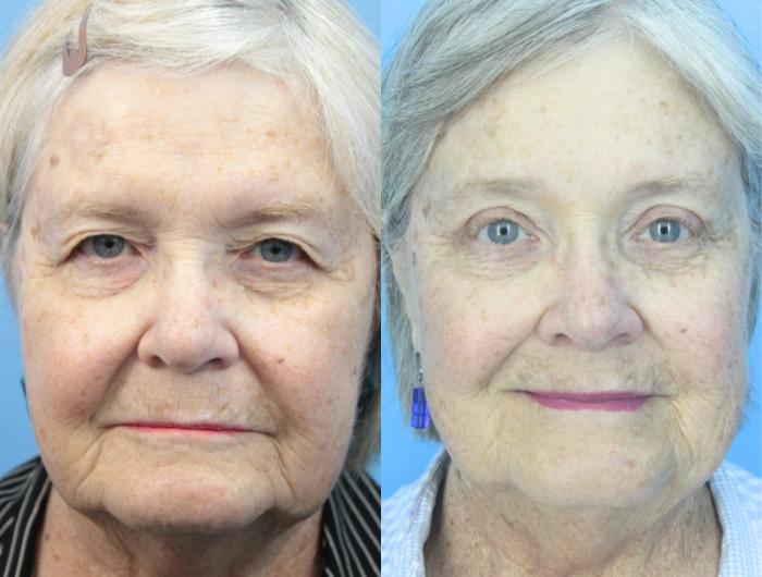 Before & After Eyelid Surgery (Upper Eyelid Lift) Case 425 Front View in West Des Moines & Ames, IA