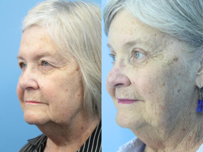 Before & After Eyelid Surgery (Upper Eyelid Lift) Case 425 Left Oblique View in West Des Moines & Ames, IA