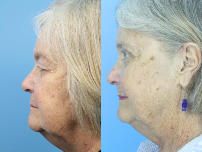 Before & After Eyelid Surgery (Upper Eyelid Lift) Case 425 Left Side View in West Des Moines & Ames, IA