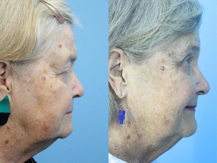 Before & After Eyelid Surgery (Upper Eyelid Lift) Case 425 Right Side View in West Des Moines & Ames, IA