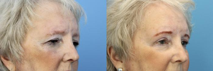 Before & After Eyelid Surgery (Upper Eyelid Lift) Case 527 Right Side View in West Des Moines & Ames, IA