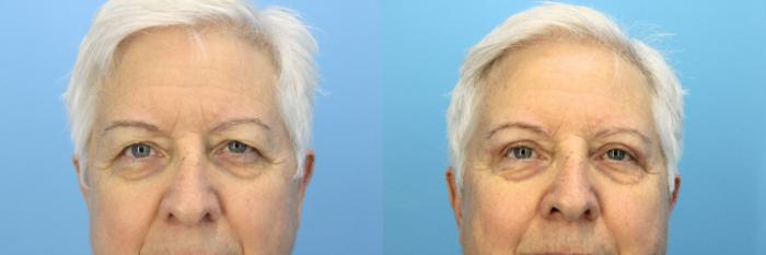 Before & After Eyelid Surgery (Upper Eyelid Lift) Case 533 Front View in West Des Moines & Ames, IA
