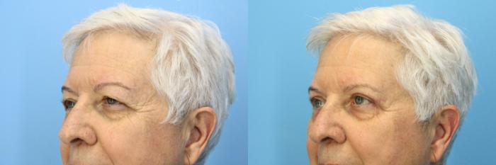 Before & After Eyelid Surgery (Upper Eyelid Lift) Case 533 Left Oblique View in West Des Moines & Ames, IA