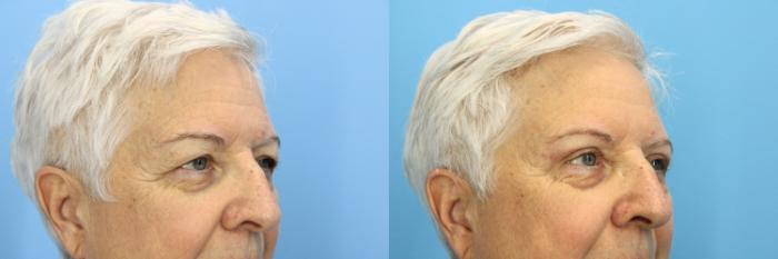 Before & After Eyelid Surgery (Upper Eyelid Lift) Case 533 Right Oblique View in West Des Moines & Ames, IA