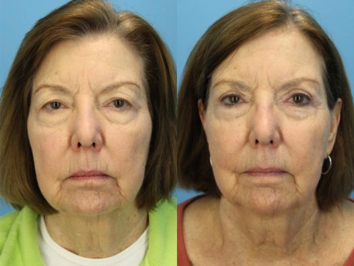 Before & After Eyelid Surgery (Upper Eyelid Lift) Case 564 Front View in West Des Moines & Ames, IA