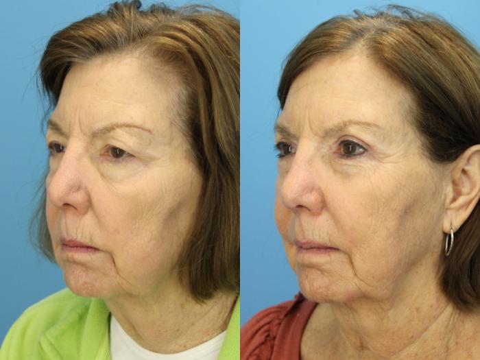 Before & After Eyelid Surgery (Upper Eyelid Lift) Case 564 Left Side View in West Des Moines & Ames, IA