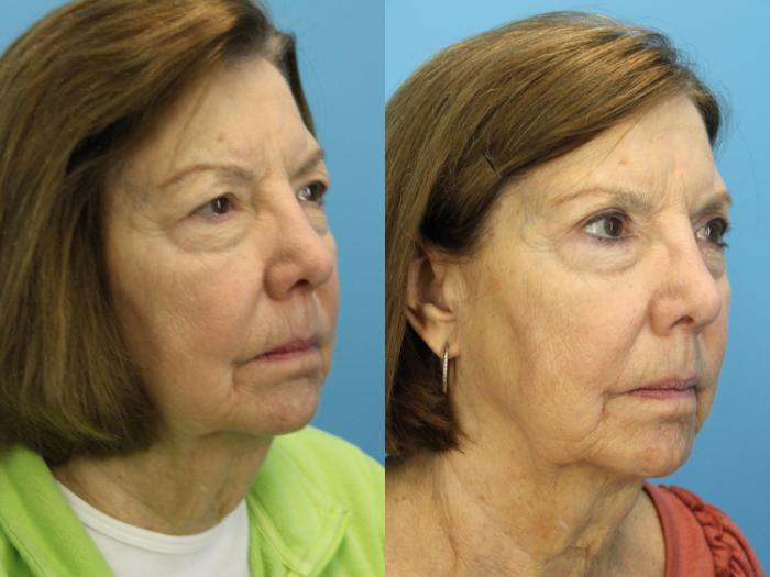 Before & After Eyelid Surgery (Upper Eyelid Lift) Case 564 Right Oblique View in West Des Moines & Ames, IA