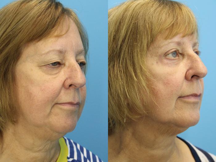 Before & After Eyelid Surgery (Upper Eyelid Lift) Case 566 Right Oblique View in West Des Moines & Ames, IA