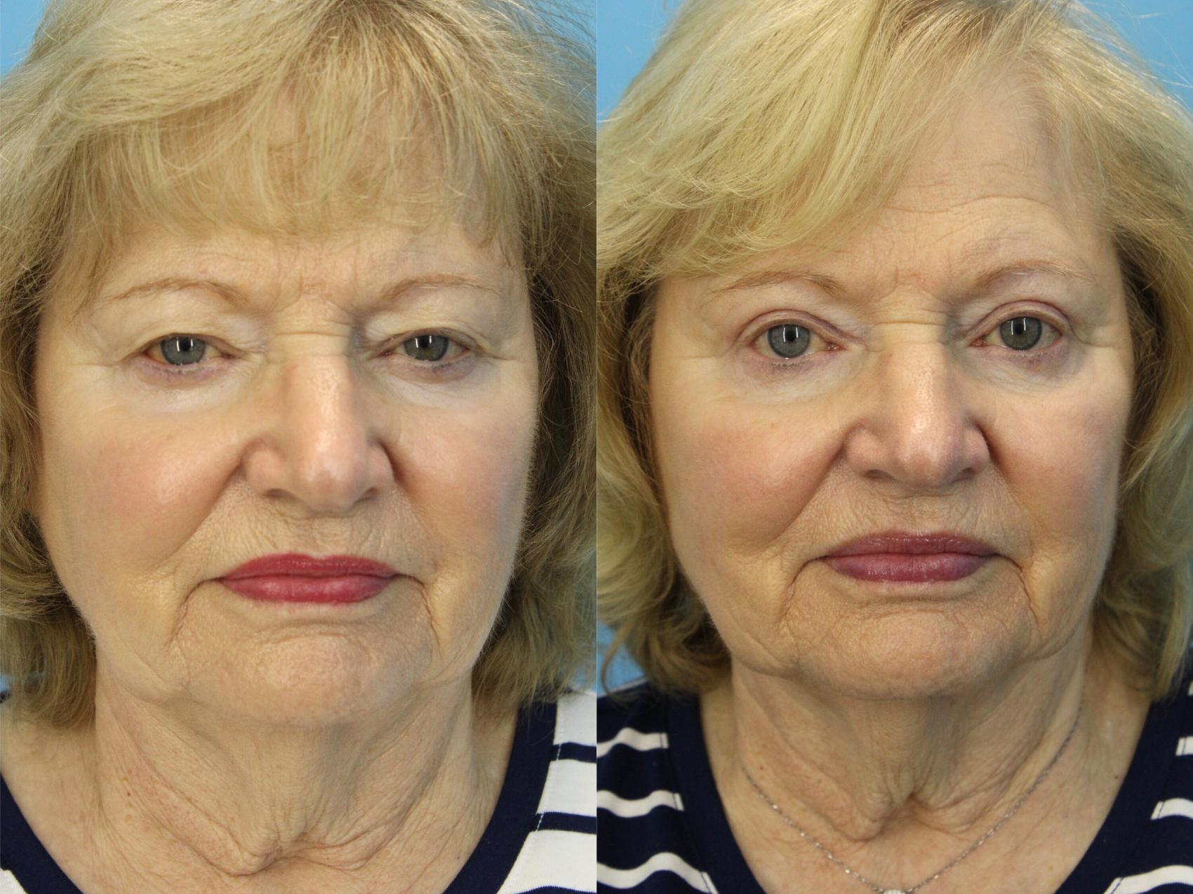 Before & After Eyelid Surgery (Upper Eyelid Lift) Case 578 Front View in West Des Moines & Ames, IA