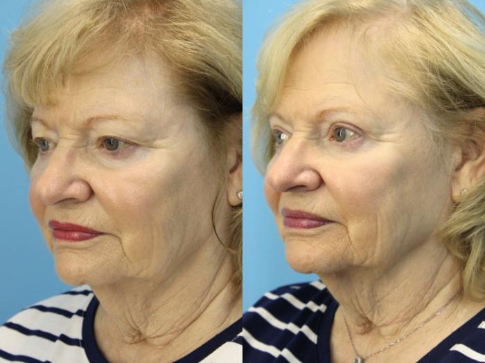 Before & After Eyelid Surgery (Upper Eyelid Lift) Case 578 Right Oblique View in West Des Moines & Ames, IA