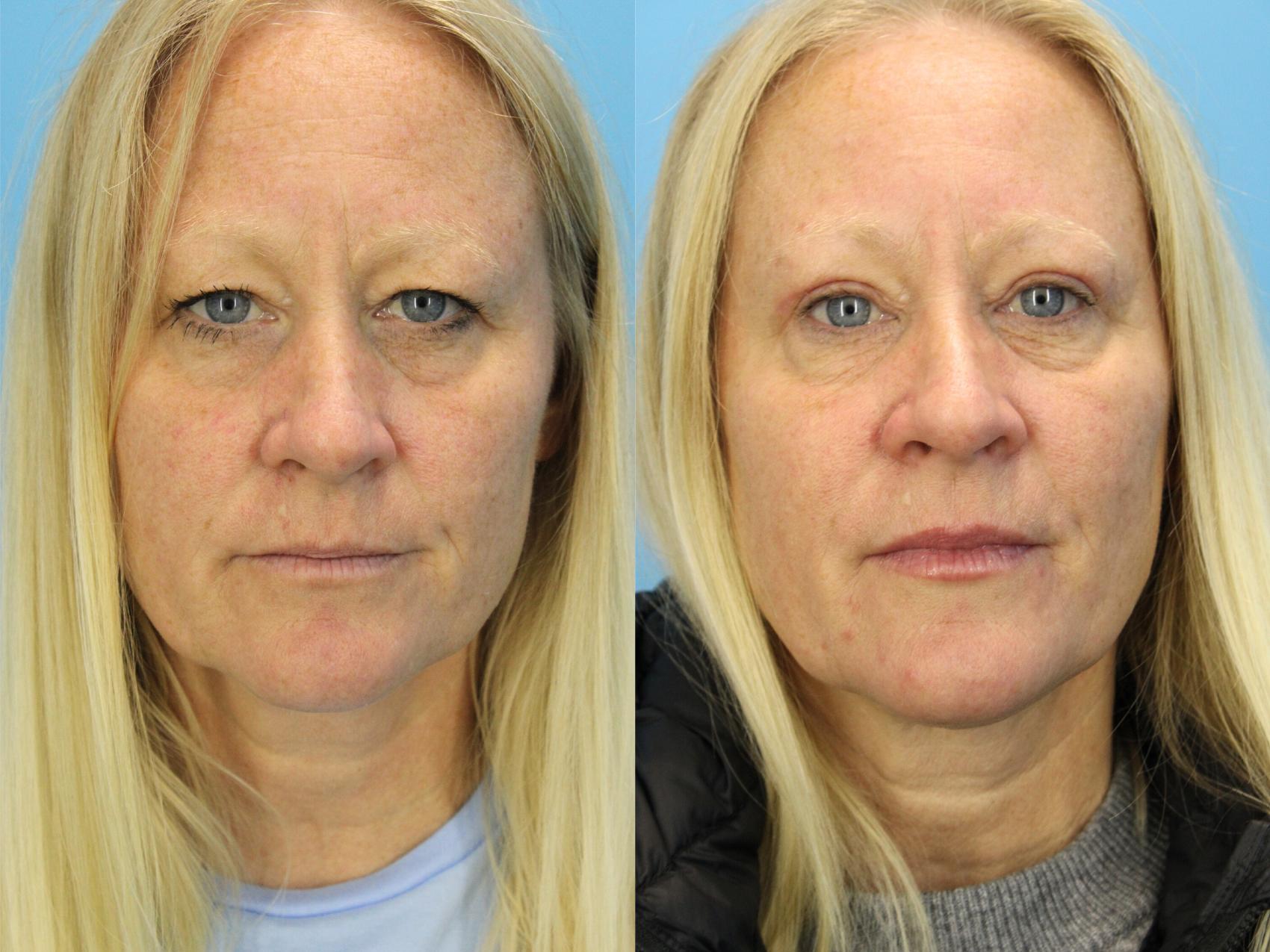 Before & After Eyelid Surgery (Upper Eyelid Lift) Case 584 Front View in West Des Moines & Ames, IA