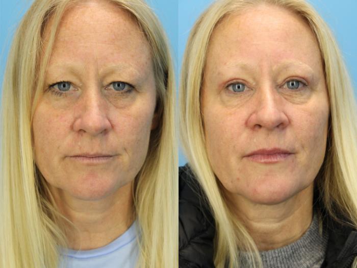 Before & After Eyelid Surgery (Upper Eyelid Lift) Case 584 Front View in West Des Moines & Ames, IA