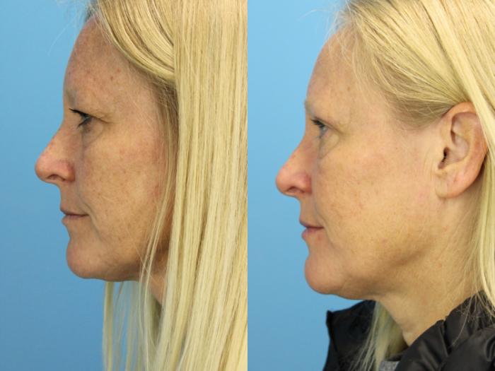 Before & After Eyelid Surgery (Upper Eyelid Lift) Case 584 Left Side View in West Des Moines & Ames, IA