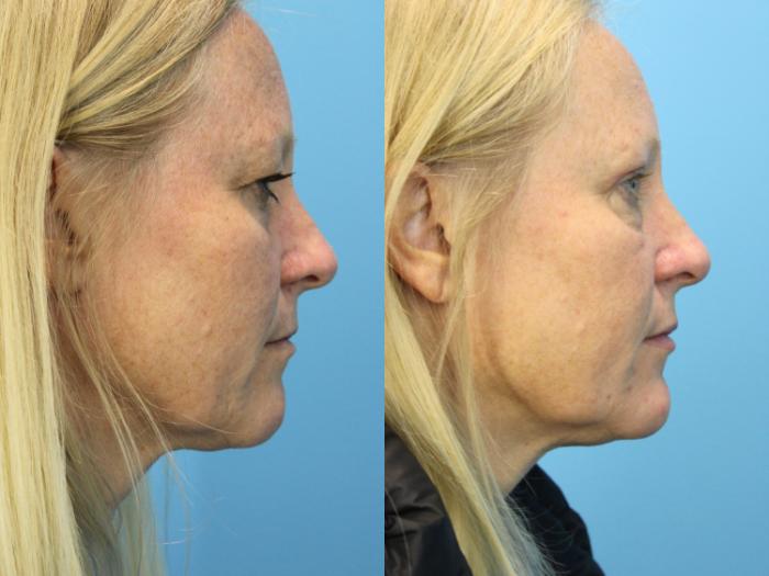 Before & After Eyelid Surgery (Upper Eyelid Lift) Case 584 Right Side View in West Des Moines & Ames, IA