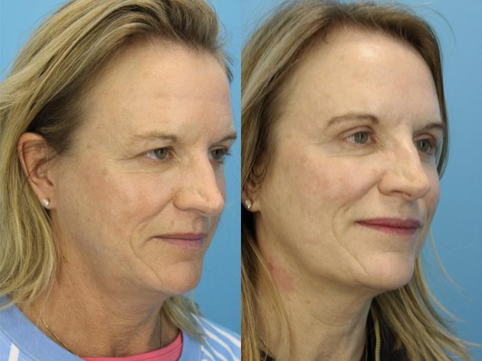 Before & After Eyelid Surgery (Upper Eyelid Lift) Case 603 Left Oblique View in West Des Moines & Ames, IA