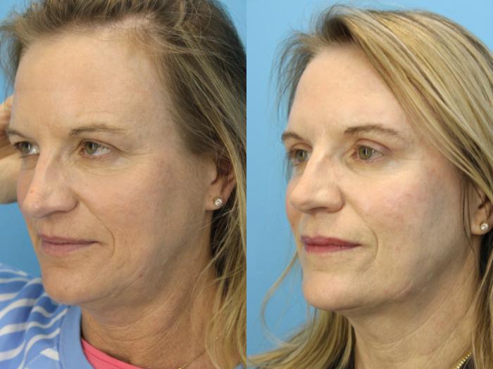 Before & After Eyelid Surgery (Upper Eyelid Lift) Case 603 Right Oblique View in West Des Moines & Ames, IA