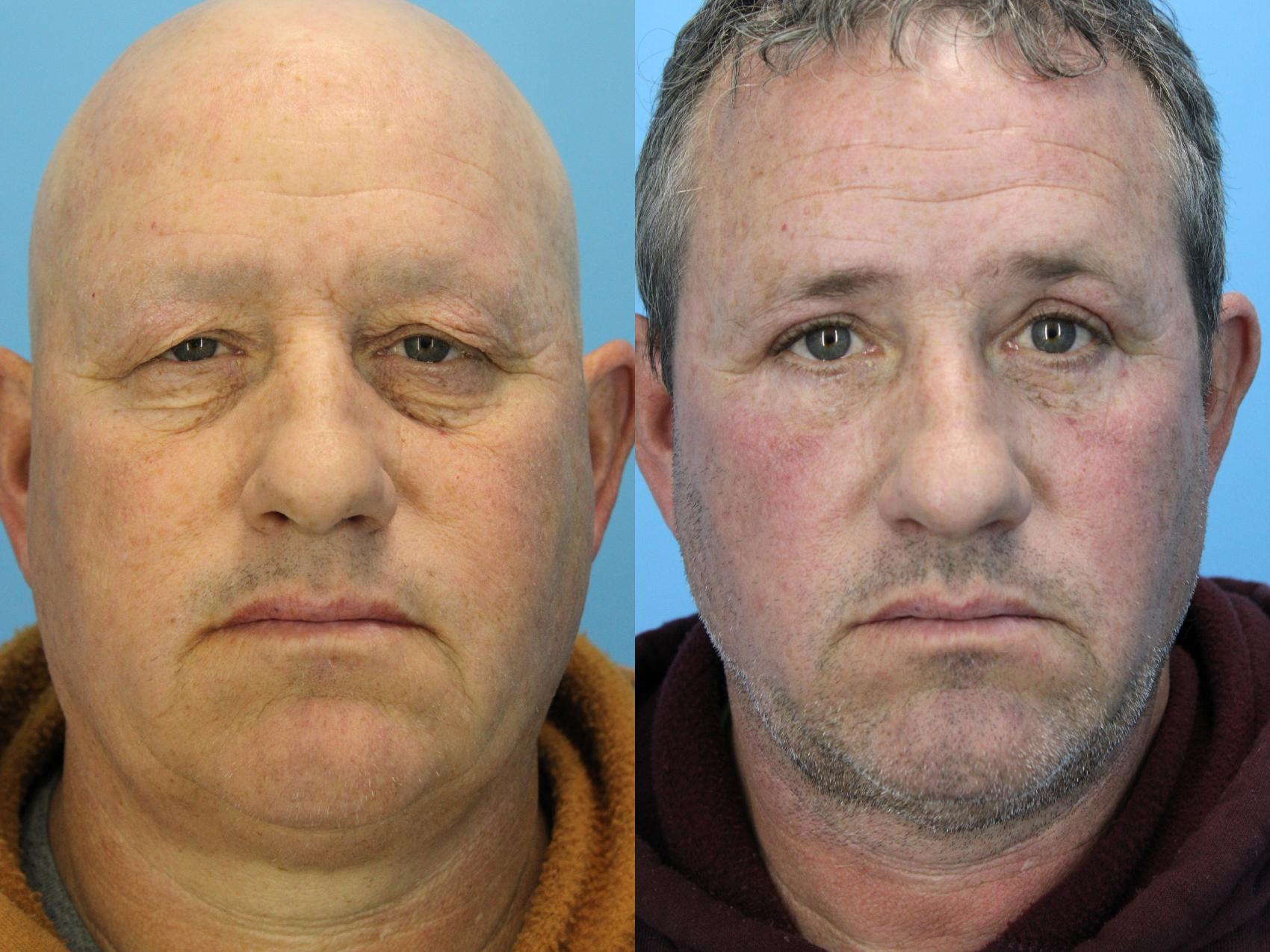Before & After Eyelid Surgery (Upper Eyelid Lift) Case 606 Front View in West Des Moines & Ames, IA