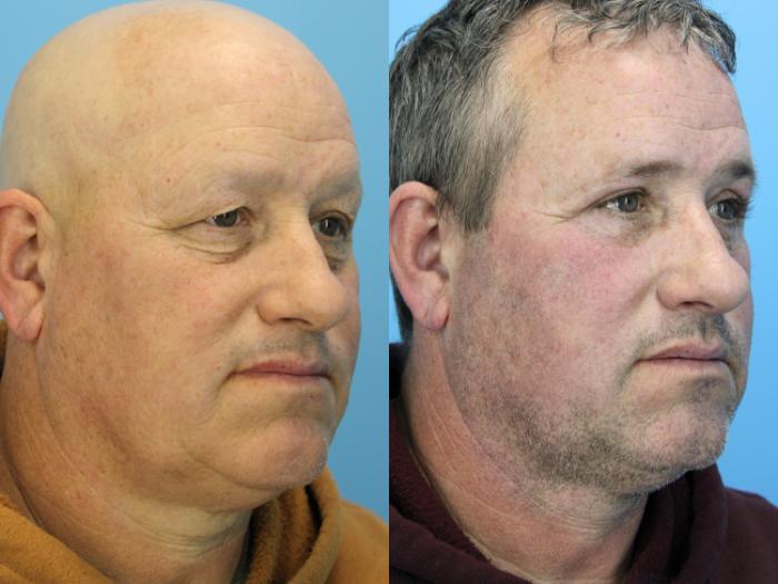 Before & After Eyelid Surgery (Upper Eyelid Lift) Case 606 Left Oblique View in West Des Moines & Ames, IA