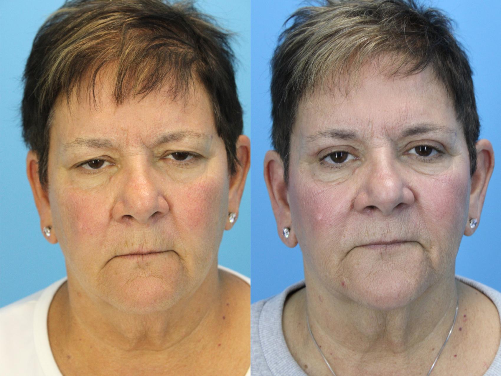 Before & After Eyelid Surgery (Upper Eyelid Lift) Case 620 Front View in West Des Moines & Ames, IA