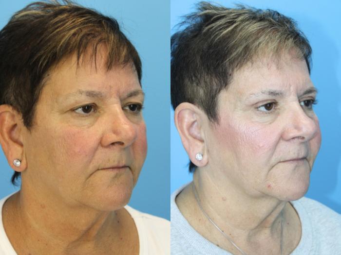 Before & After Eyelid Surgery (Upper Eyelid Lift) Case 620 Left Oblique View in West Des Moines & Ames, IA