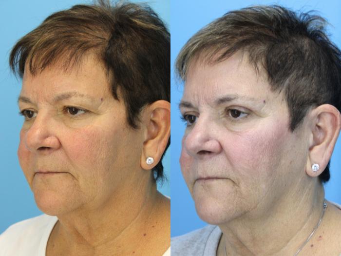 Before & After Eyelid Surgery (Upper Eyelid Lift) Case 620 Right Oblique View in West Des Moines & Ames, IA
