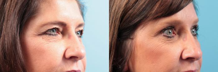 Before & After Eyelid Surgery (Upper Eyelid Lift) Case 63 View #2 View in West Des Moines & Ames, IA