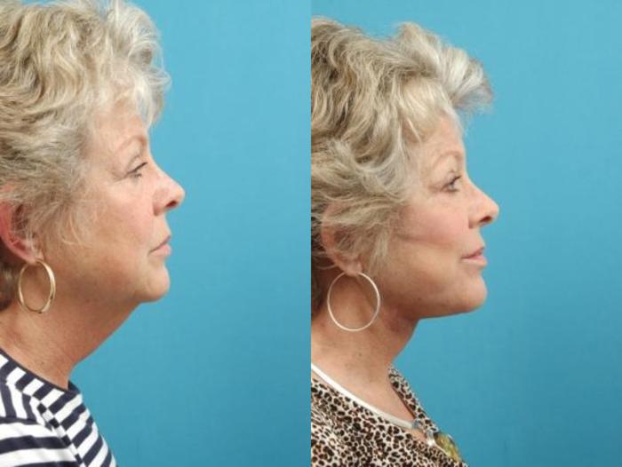 Before & After Facial Liposuction Case 10 View #1 View in West Des Moines, IA