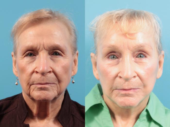 Before & After Facelift Case 110 Front View in West Des Moines & Ames, IA