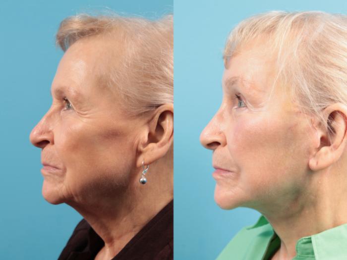 Before & After Facelift Case 110 Left Side View in West Des Moines & Ames, IA