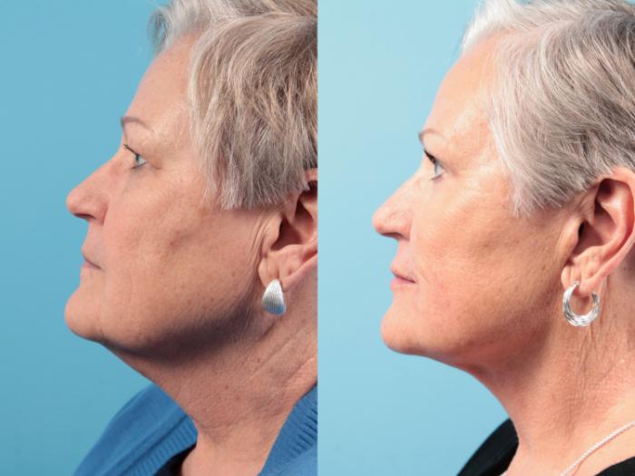 Before & After Facelift Case 111 Left Side View in West Des Moines & Ames, IA