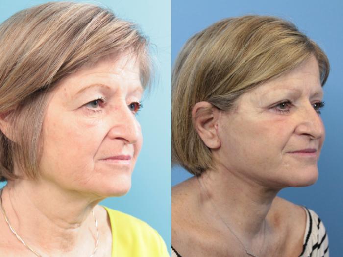 Before & After Facelift Case 114 Right Oblique View in West Des Moines & Ames, IA