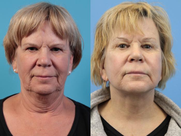 Before & After Facelift Case 120 View #1 View in West Des Moines & Ames, IA