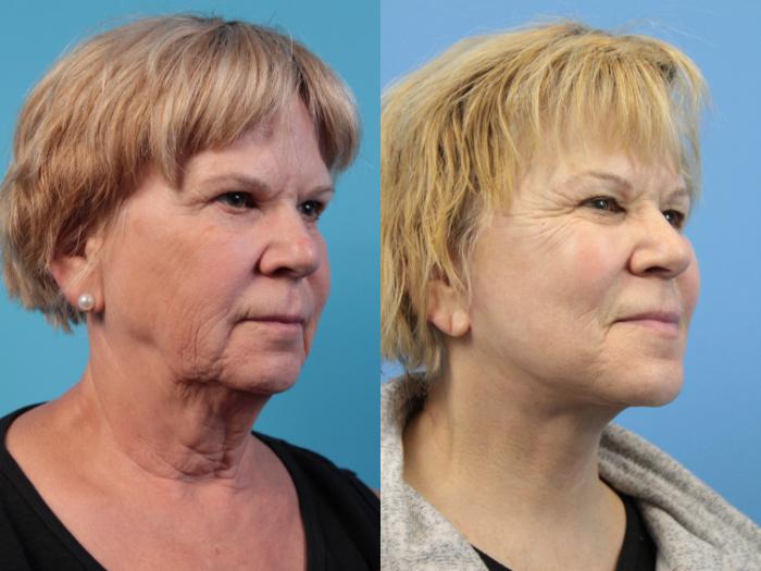 Before & After Facelift Case 120 View #2 View in West Des Moines & Ames, IA