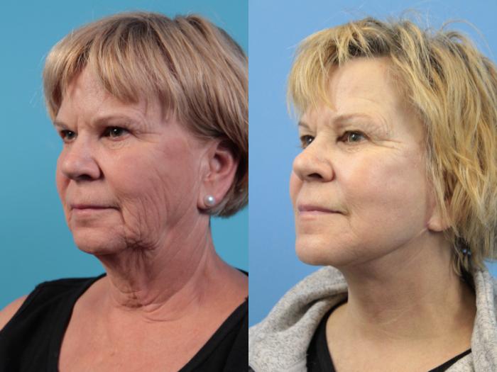 Before & After Facelift Case 120 View #3 View in West Des Moines & Ames, IA
