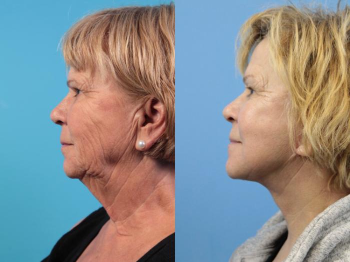 Before & After Facelift Case 120 View #4 View in West Des Moines & Ames, IA