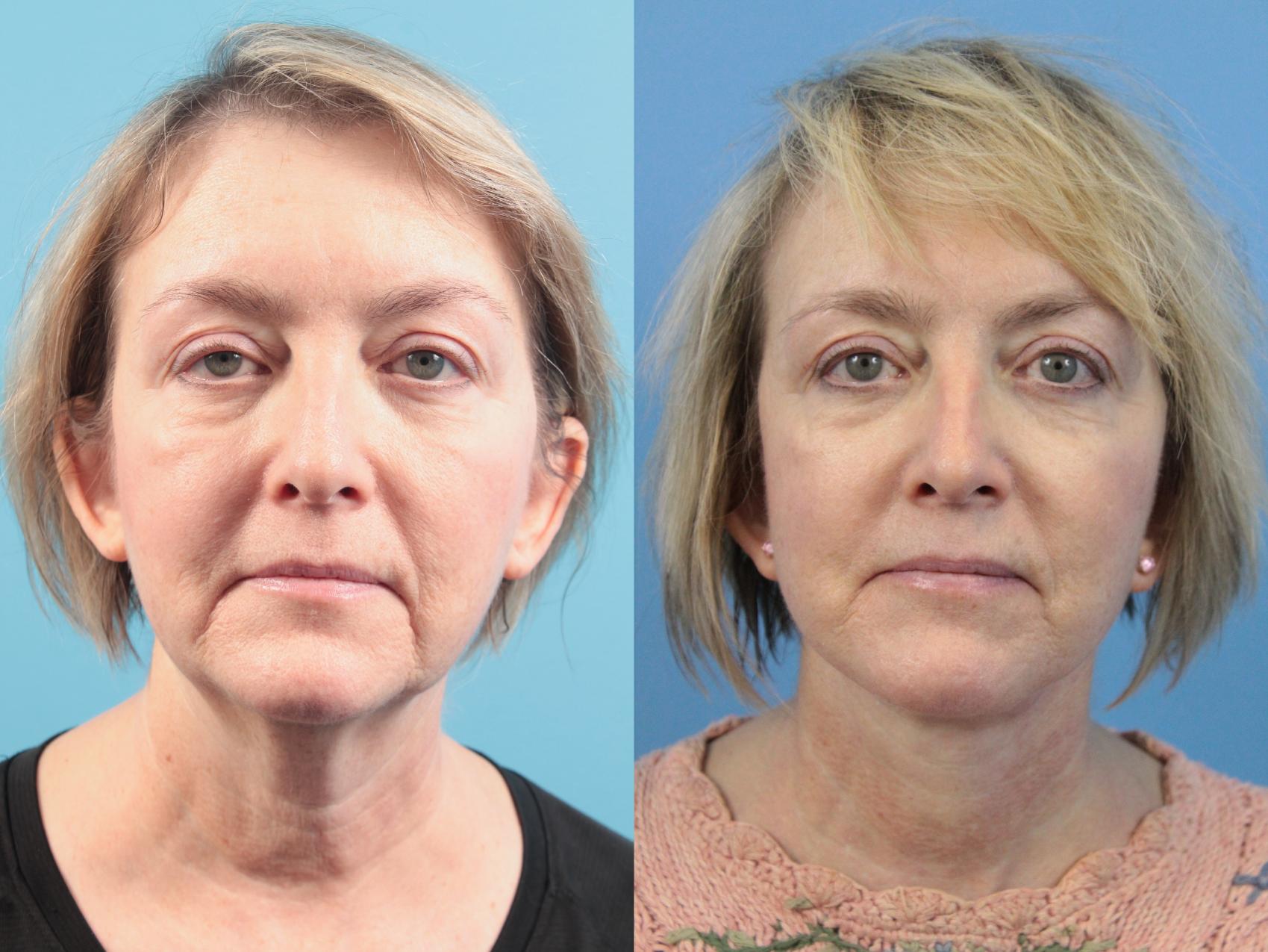 Before & After Facial Liposuction Case 124 Front View in West Des Moines, IA