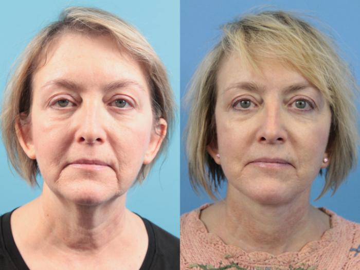 Before & After Facial Liposuction Case 124 Front View in West Des Moines & Ames, IA