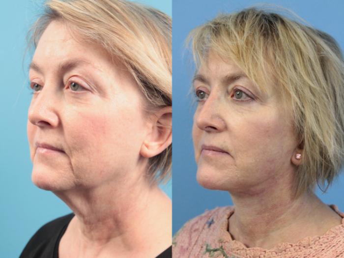 Before & After Facial Liposuction Case 124 Left Oblique View in West Des Moines & Ames, IA