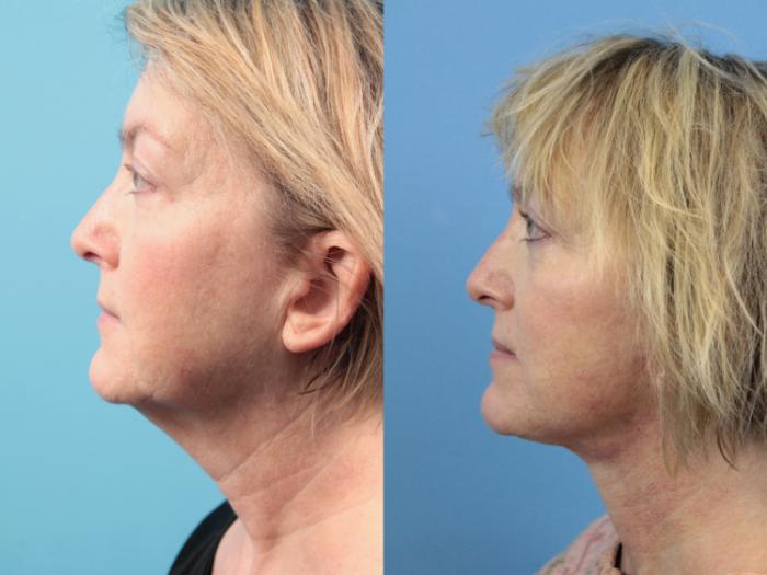 Before & After Facelift Case 124 Left Side View in West Des Moines & Ames, IA