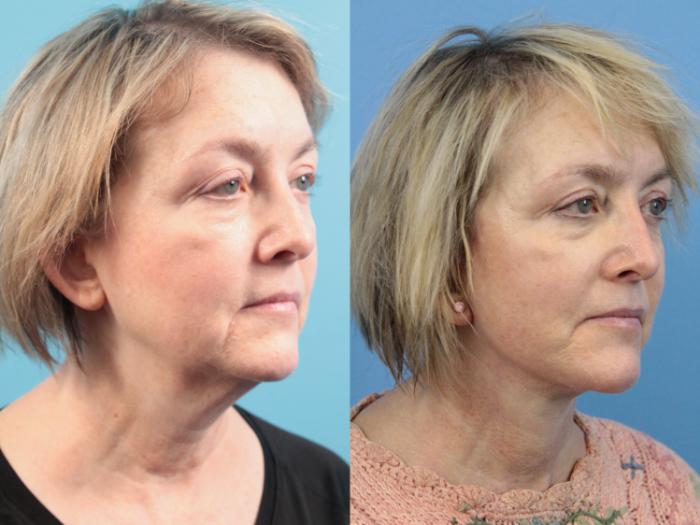 Before & After Facial Liposuction Case 124 Right Oblique View in West Des Moines & Ames, IA