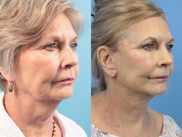 Before & After Facelift Case 132 View #1 View in West Des Moines & Ames, IA