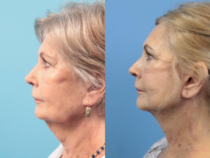 Before & After Facelift Case 132 View #2 View in West Des Moines & Ames, IA