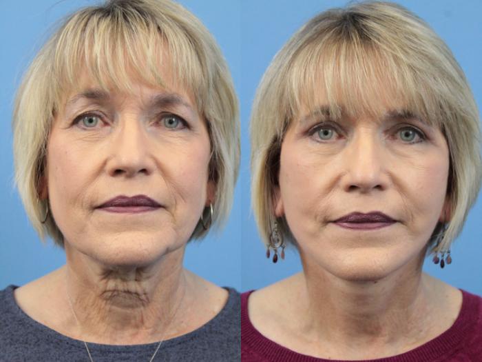 Before & After Blepharoplasty (Upper Eyelid Lift) Case 133 View #1 View in West Des Moines & Ames, IA