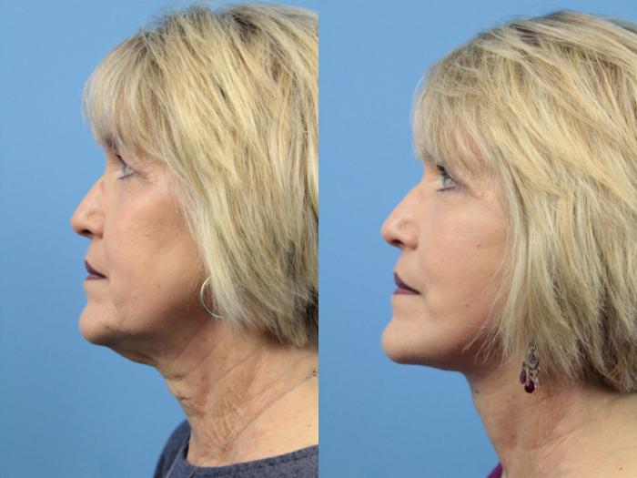Before & After Blepharoplasty (Upper Eyelid Lift) Case 133 View #2 View in West Des Moines & Ames, IA