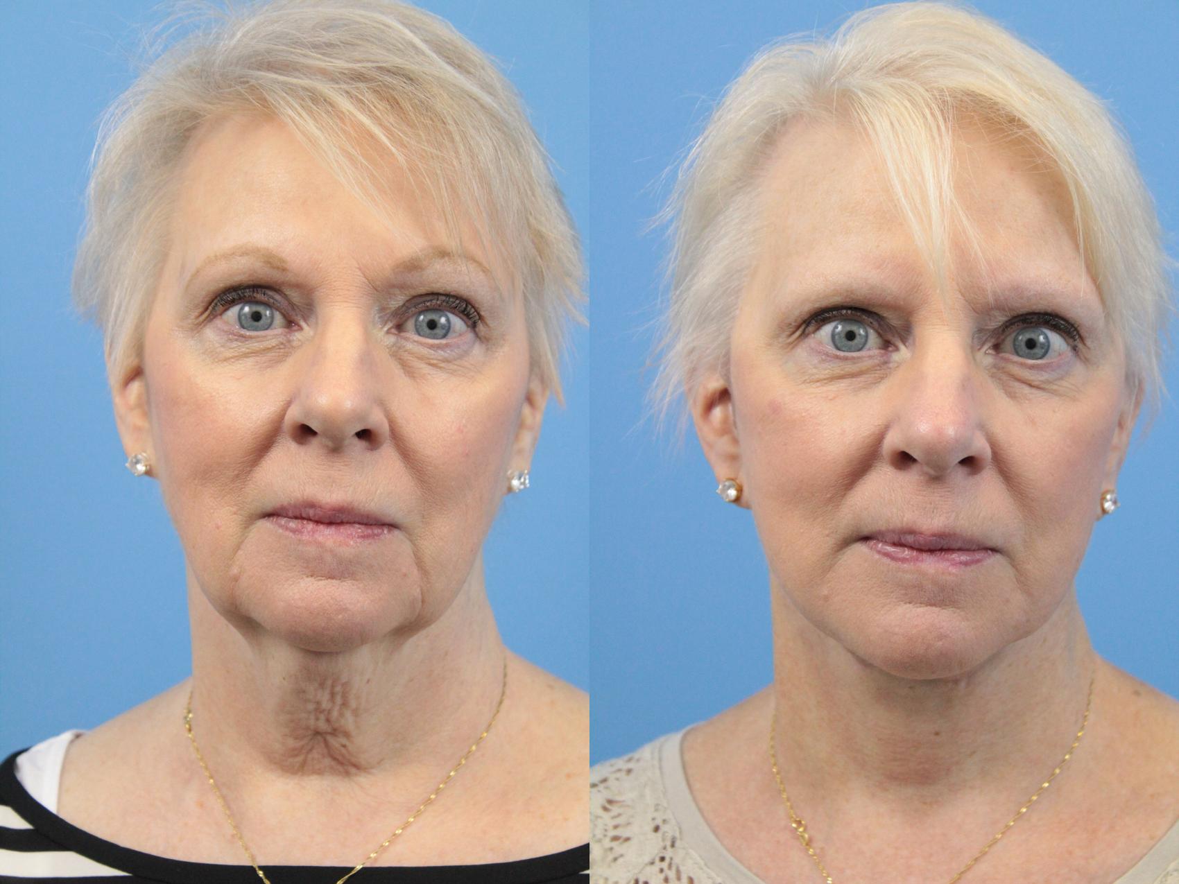 Before & After Facial Liposuction Case 135 View #1 View in West Des Moines, IA