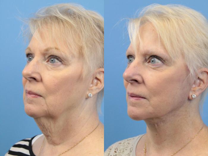 Before & After Facial Liposuction Case 135 View #2 View in West Des Moines & Ames, IA