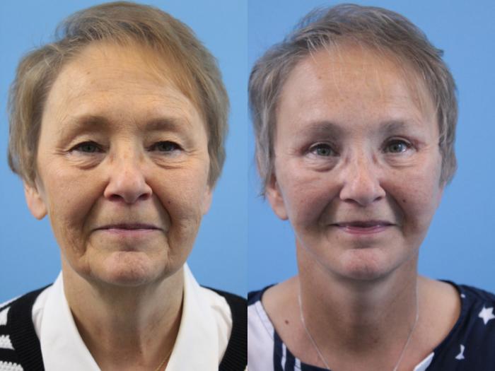 Before & After Facelift Case 155 View #1 View in West Des Moines & Ames, IA