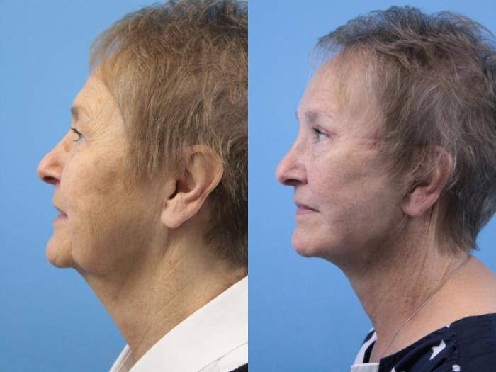 Before & After Facelift Case 155 View #2 View in West Des Moines & Ames, IA